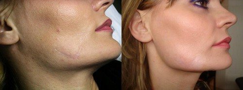 Заболевание кожи рубцы на лице